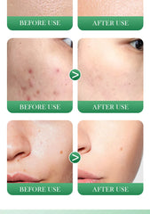 10pcs Salicylic Acid Acne Removing facial mask Acne Treatment Moisturizing Brightening skincare Face Mask Skin Care