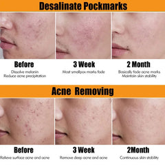 Tea Tree Acne Removal Serum Repair Acne Serum Oil Shrink Pore Remove Blackheads Facial Cleaning Fade Acne Marks Whitening