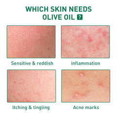 Tea Tree Oil Ac-ne Pim-ple Removing Lightens Ac-ne Marks Repairing Sensitivity Redness Itching Reddish Facial Essence Oil